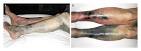 pemphigoid, atopic dermatitis; can take months, years to resolve;