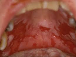 Attēlu rezultāti vaicājumam “Pemphigus borealis”