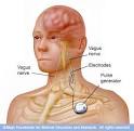 <b>Vagus nerve</b> stimulation