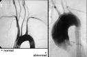 <b>Takayasu's arteritis</b> into