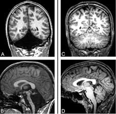 Image result for no brain