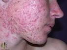 acne-face_15_1.jpg
