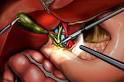 Robot-Assisted Laparoscopic Procedures - Health - Beliefnet.