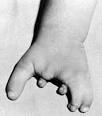 UNSW Embryology- Musculoskeletal System - Limb Development ...