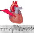 Ion Channel Lab - Cardiac Arrhythmia