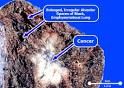Lung Cancer Symptoms, Stages, Survival, Statistics, Treatment ...