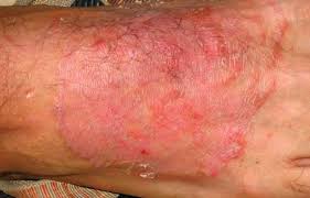 Image result for tinea corporis