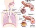 Pneumonia Guide: Causes, Symptoms and Treatment Options