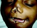 <b>Lesch</b>-<b>Nyhan syndrome</b>