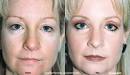 Blue Peel from Obagi, Washington, Plastic Surgery, Steven Blair Hopping, MD, ... - blue_peel2