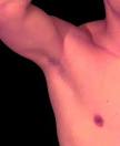 Surface Anatomy - Axillary Lymphatics