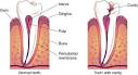 Why Do People Get Tooth Cavities, Why Cavities Happen - Cure Tooth ...