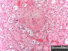 Hyaline <b>arteriolosclerosis</b>