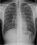 <b>infections opportunistes</b>