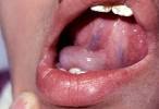 <b>ranula</b> mondbodem