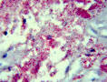 <b>TUBERCULOSIS GANGLIONAR</b>