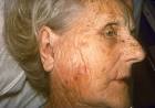 Staph Infection - <b>Parotitis</b>