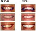 Laser Bleaching | Karen Hom DDS | Las Vegas Dentist