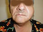 <b>Parotitis</b>.