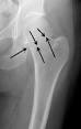 Hip Fractures - OrthoInfo - AAOS