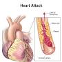 search Heart attack from my.clevelandclinic.org
