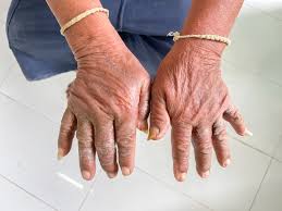 Attēlu rezultāti vaicājumam “Scleroderma”