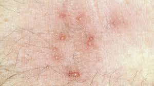 Image result for bed bug bites
