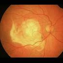 Disease. Macular degeneration