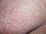 <b>Mycosis fungoides</b>