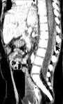 <b>spinal subdural hemorrhage</b>
