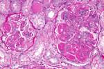 lupus <b>nephritis</b> -a- very