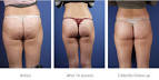 How to Get Rid of Cellulite with AWT Cellulite Treatment