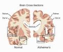 Alzheimer's disease - symptoms, causes, diagnosis and treatment by ...