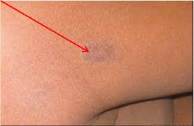 Image result for tinea corporis