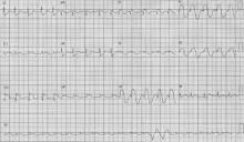 Severe coronary spasm in elderly man with respiratory and renal ...