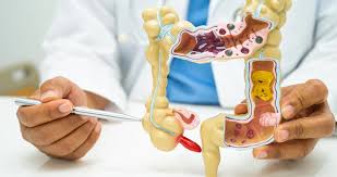 Image result for boala crohn si schizofrenie paranoida