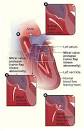 Mitral Valve Disease and the Cavalier King Charles Spaniel
