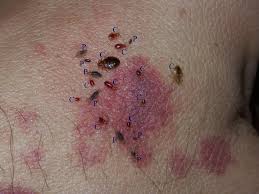 Image result for bed bug bites