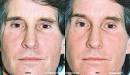 Blue Peel from Obagi, Washington, Plastic Surgery, Steven Blair Hopping, MD, ... - blue_peel3