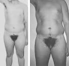 File:Grade 3 partial androgen insensitivity syndrome.jpg ...