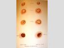 Smallpox and <b>Cowpox</b> Vesicles