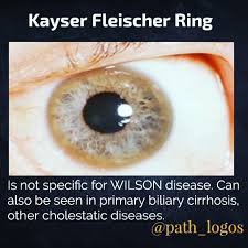 Kuvahaun tulos haulle Kayser-Fleischer