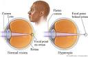 Farsightedness (hyperopia) - Health.
