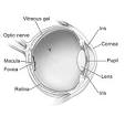A <b>cataract</b> can occur in either
