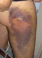 <b>Hematoma</b>