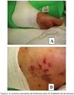 Acta Médica Costarricense - <b>Choque séptico</b> por ehrliquiosis