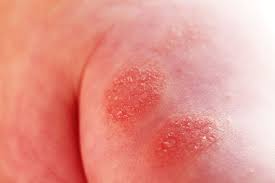 Attēlu rezultāti vaicājumam “Diderma simplex”