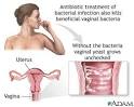 Bacterial Vaginosis Gone