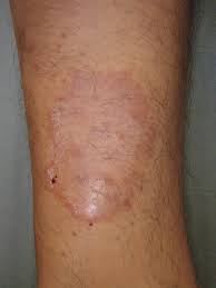 Image result for tinea corporis