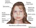 <b>Síndrome</b> de alcoholismo fetal